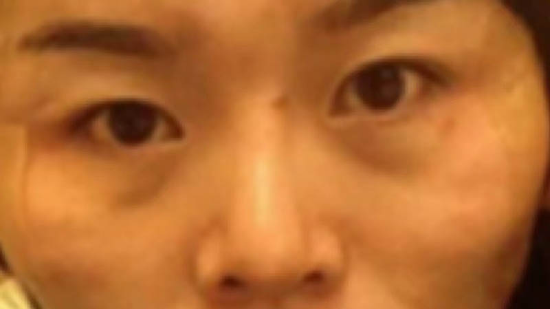 疤痕修复治疗前